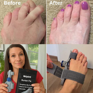 Mrjoint Bunion Fix